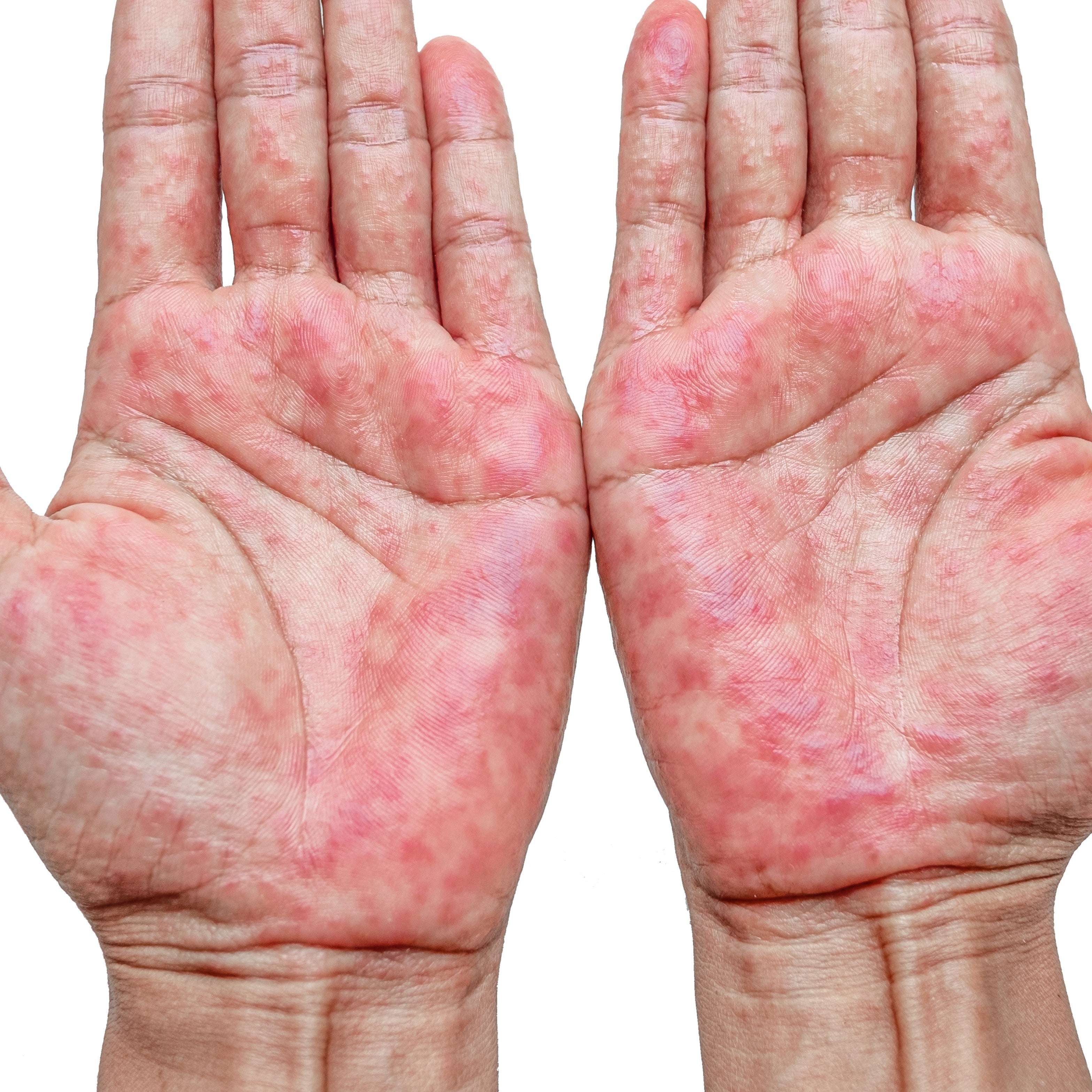 Eczema Treatment