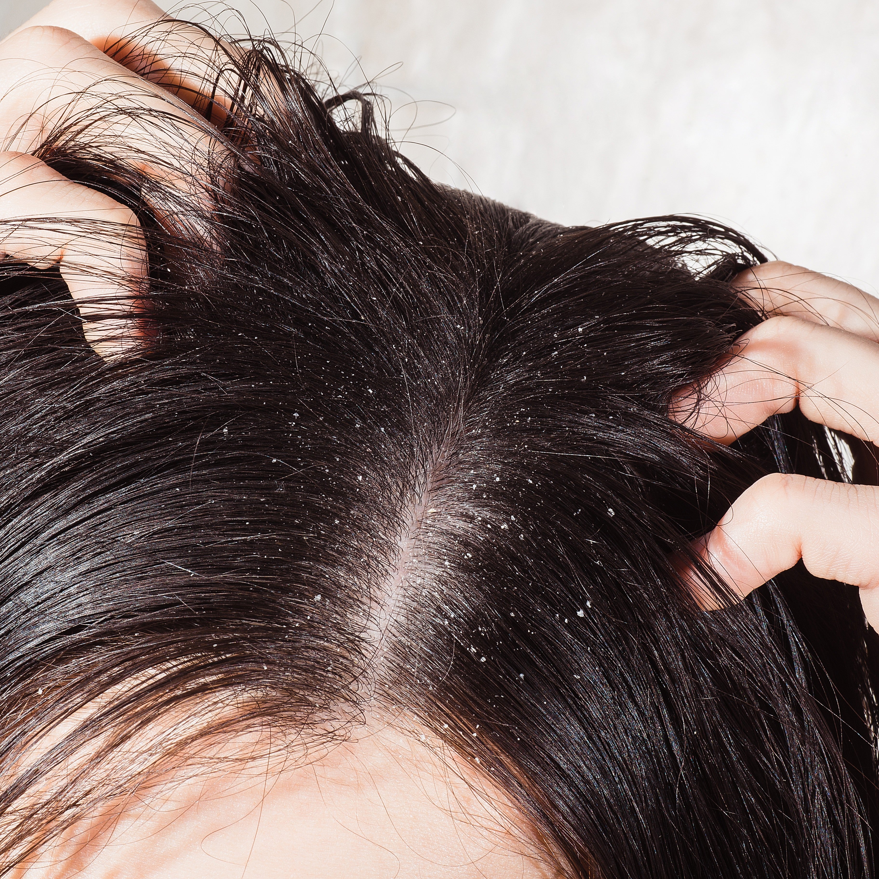 Scalp Treatment