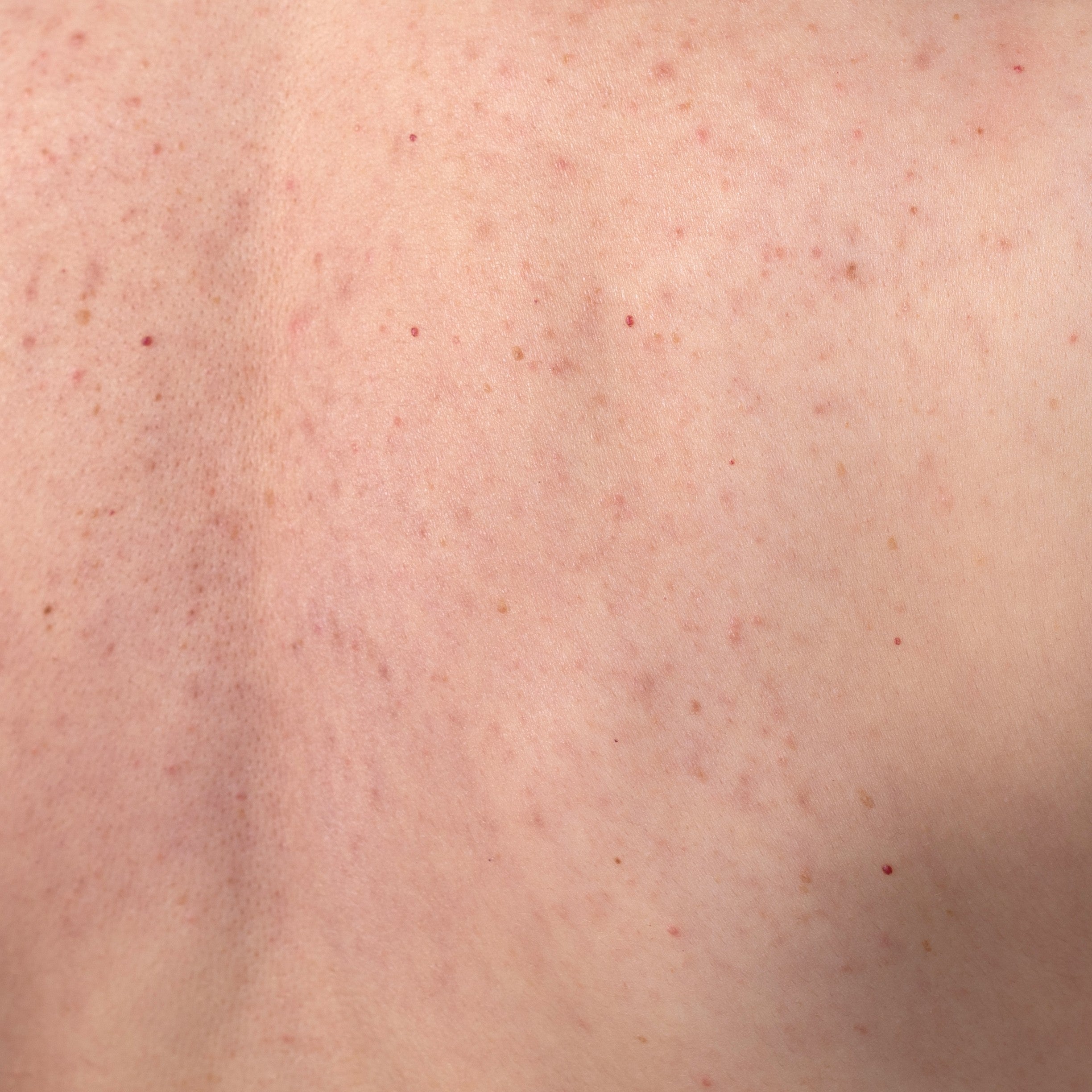 Body Acne Treatment