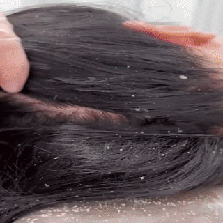 Atoskin – Specialized Shampoo for Seborrheic Dermatitis & Folliculitis-Prone Scalp