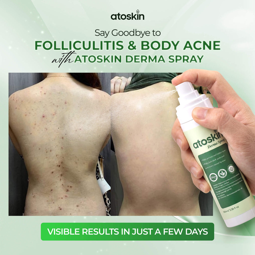 Atoskin Derma Spray – Advanced Folliculitis & Back Acne Treatment Spray (3.4 oz)