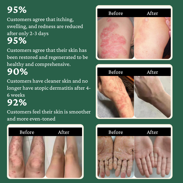 Atoskin – Specialized Body Wash for Eczema, Psoriasis & Dermatitis-Prone Skin