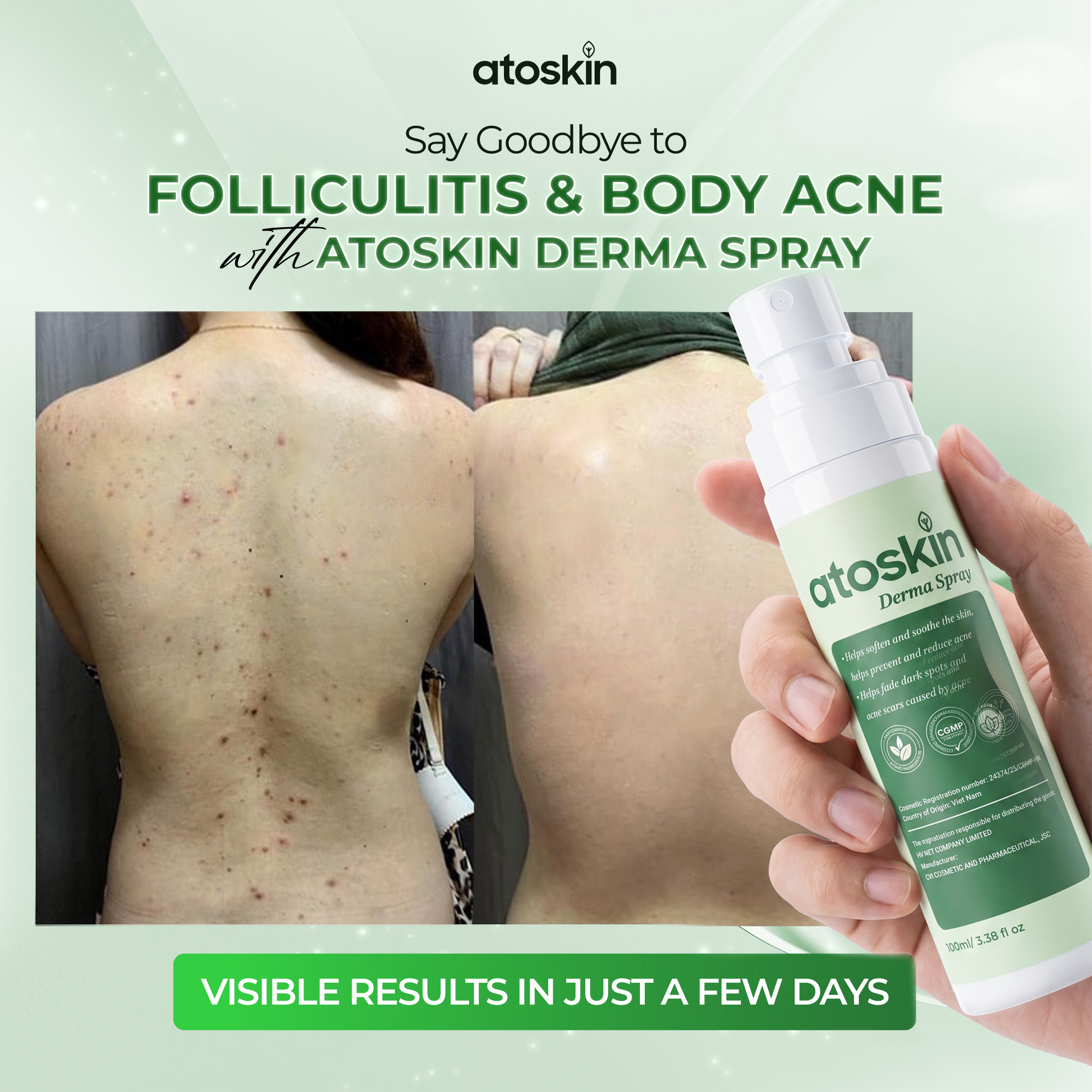 Atoskin Derma Spray – Advanced Folliculitis & Back Acne Treatment Spray (3.38 oz)