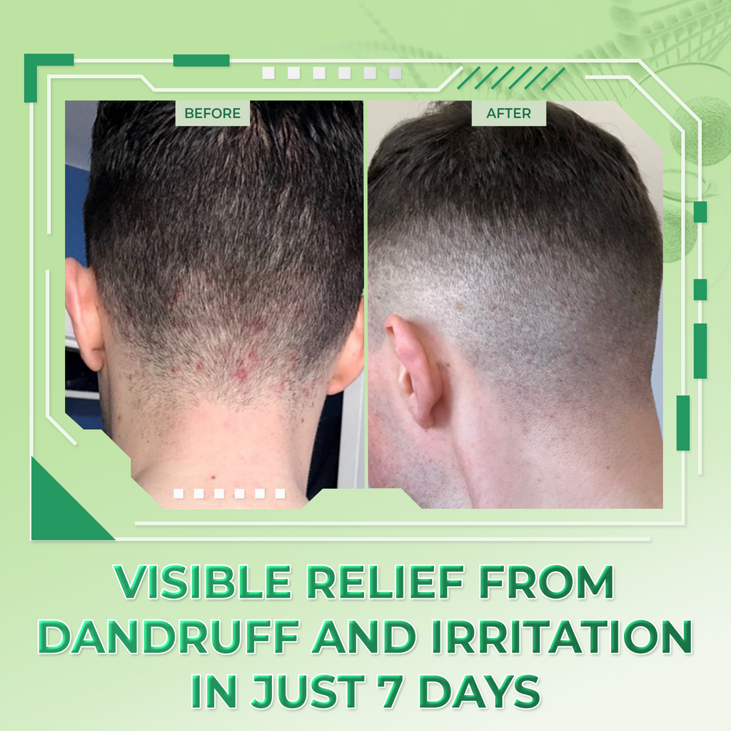 Atoskin Shampoo for Seborrheic Dermatitis & Folliculitis-Prone Scalp