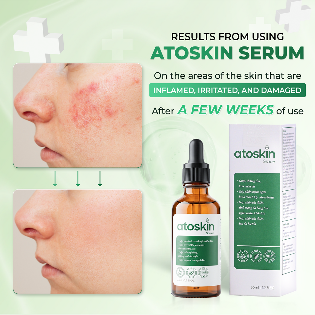 Atoskin Serum - for Eczema, Psoriasis, Itchy Skin and Dermatitis Irritation (1.7 fl oz)