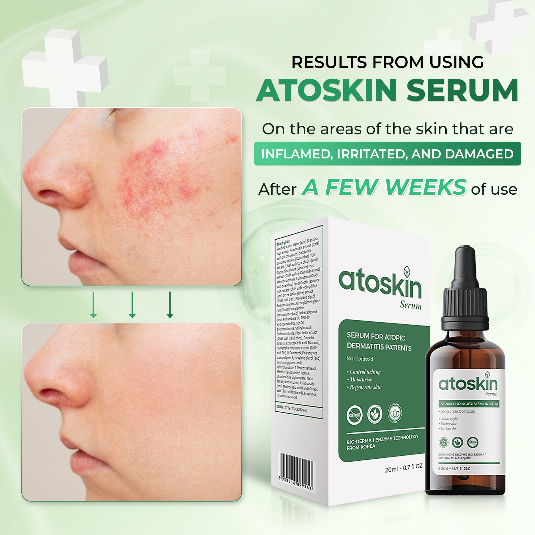 Atoskin Serum for Eczema, Psoriasis, Itchy Skin and Dermatitis Irritation, with Biosaccharide Gum-1 and RicoBio JA7 - for Atopic Dermatitis Patents (1.7 fl oz)