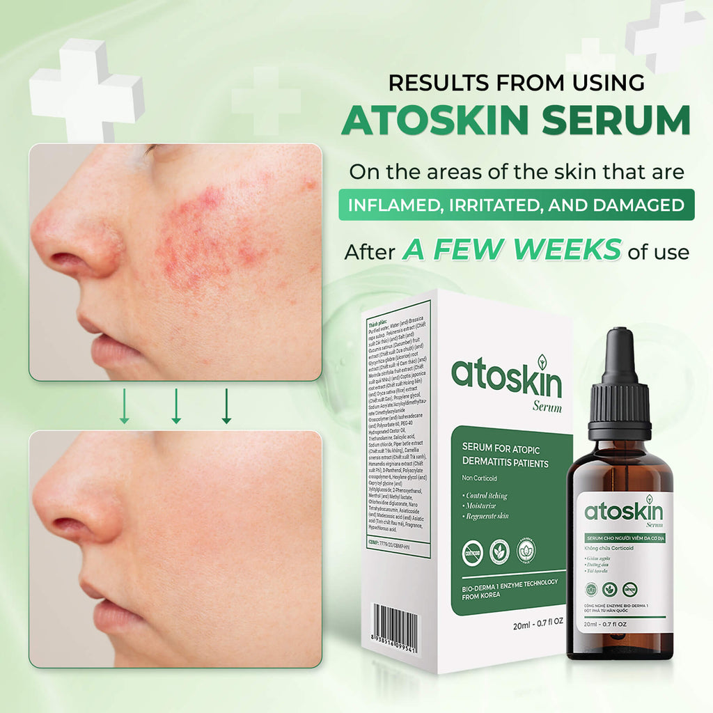 Atoskin Serum - for Eczema, Psoriasis, Itchy Skin and Dermatitis Irritation (1.7 fl oz)