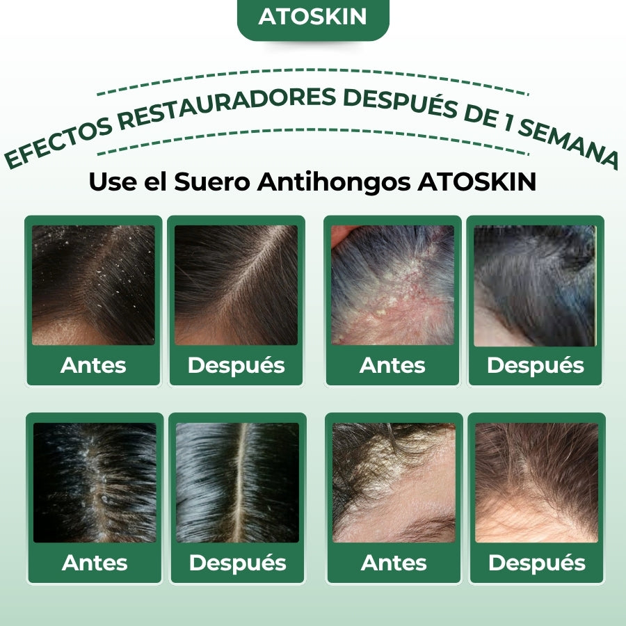 Atoskin – Specialized Shampoo for Seborrheic Dermatitis & Folliculitis-Prone Scalp
