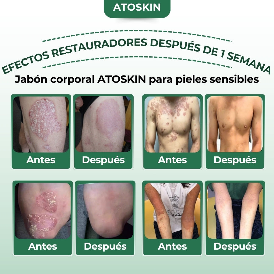 Atoskin – Specialized Body Wash for Eczema, Psoriasis & Dermatitis-Prone Skin